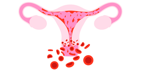Abnormal Uterine Bleeding