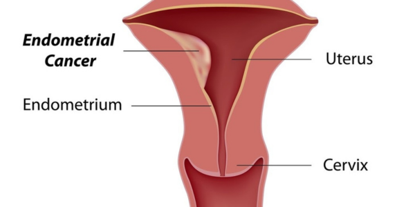 Endometrial Sampling