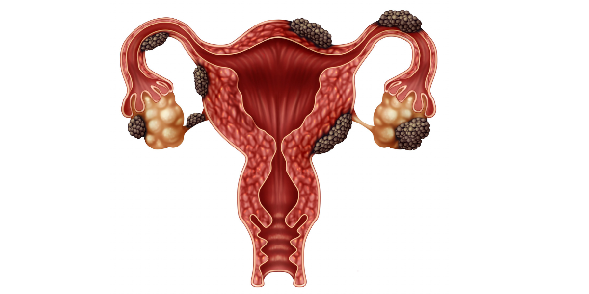 Endometriosis Treatment in Navi Mumbai by Dr. Priya Khamatkar