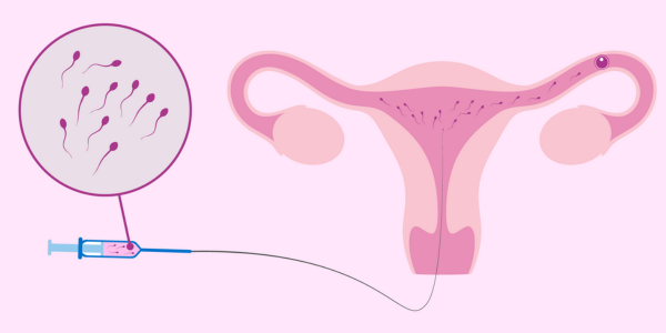 Insemination Process