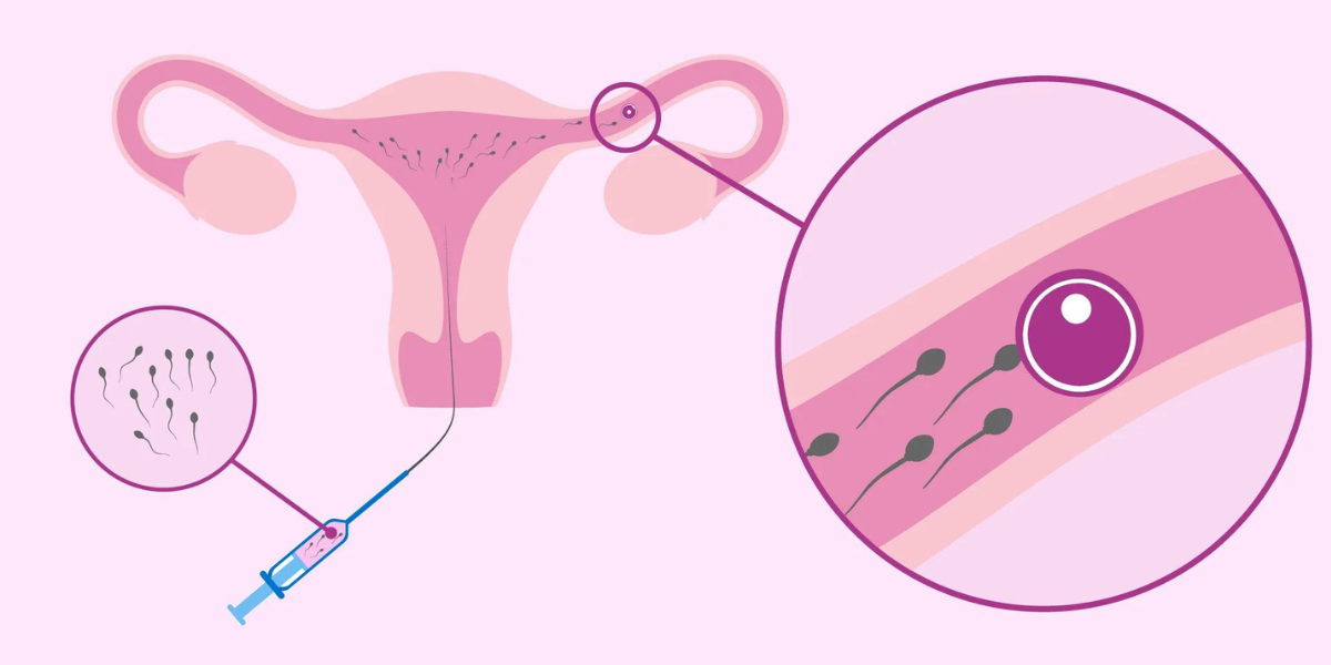 Intrauterine Insemination (IUI) Treatment in Navi Mumbai by Dr. Priya Khamatkar