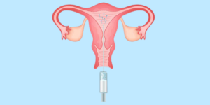 Intrauterine Insemination Icon