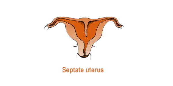 Recurrent Miscarriages