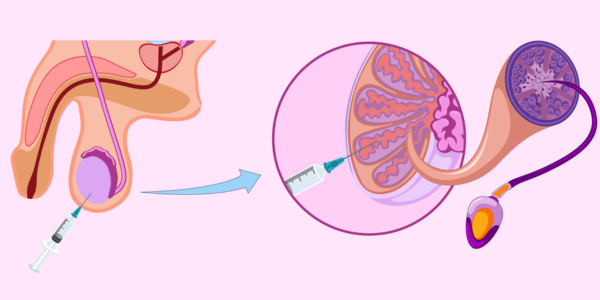 Sperm Retrieval
