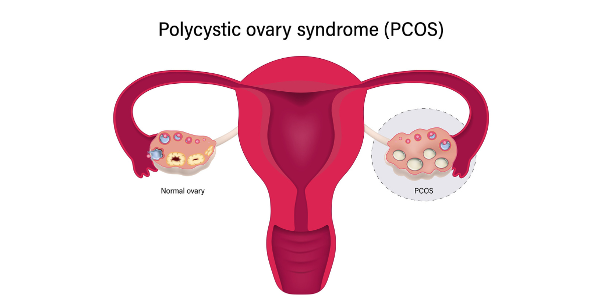 Infertility Assessment for PCOS in Navi Mumbai by Dr. Priya Khamatkar